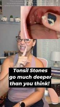 Tonsil stones go much deeper than you think! #ad #tonsilstones #guthealth #holistic #healthtips