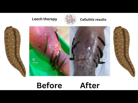 What is the best natural treatment for cellulitis? ( LEECH THERAPY FOR CELLULITIS ) #kzhijama 