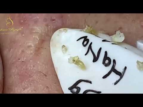 Loan Nguyen Acne Treatment 36qq