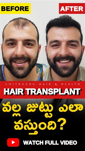 హెయిర్ ట్రాన్స్ ప్లాంట్ వల్ల జుట్టు ఎలా వస్తుంది | Before After Transplant#shorts #shortsviral #hair