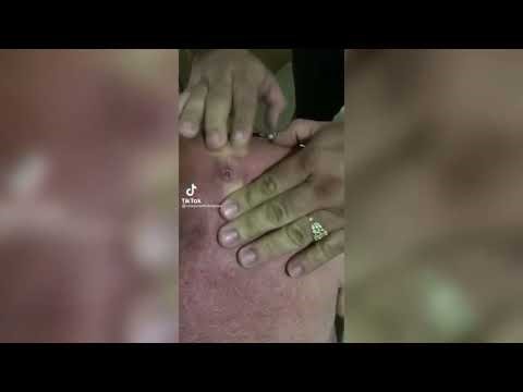 Pimple Popping - Ultimate Pimple Popping Compilation#135