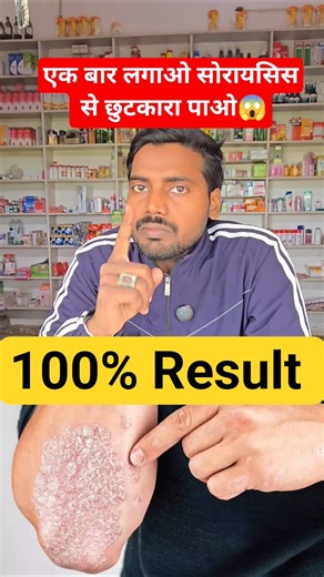 Psoriasis Treatment in Hindi #shorts #psoriasis #viral #youtubeshorts