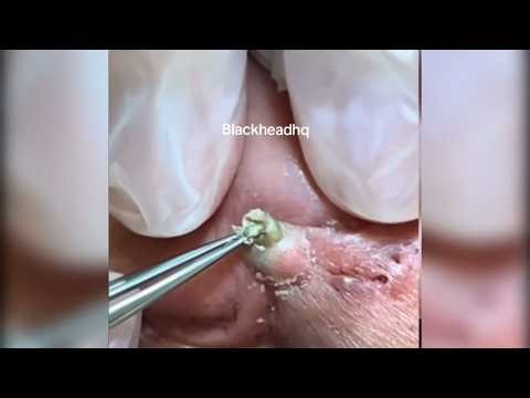 Popping huge blackheads and Pimple Popping - Best Pimple Popping Videos #103