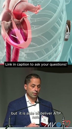 What does modular ATP actually mean for leadless pacing and ICD workflows?