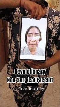 Non-Surgical Facelift Transformation | Permanent Thread Facelift 1 Year Results