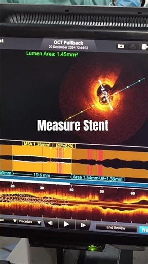 OCT- Optical Coherence Tomography || #cover #funny #live #comedy
