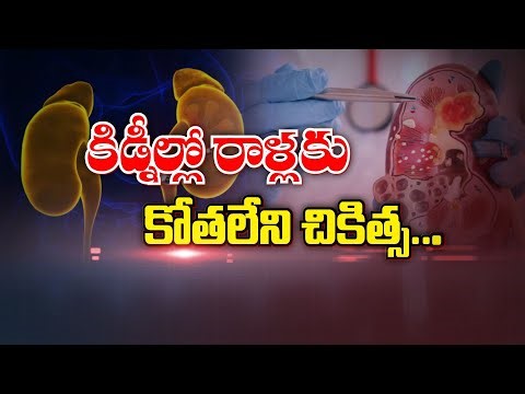 కిడ్నీల్లో రాళ్లకు కోతలేని చికిత్స... | Lithotripsy for Kidney stones | Sukhibhava | ETV Life