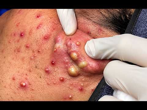 New 2026 🤯 Most Satisfying Acne Extraction! Giant Pimples & Deep Blackheads #10211