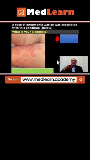 Pneumonia (Quick note) #medicalstudent #medicaleducation #medicalcollege