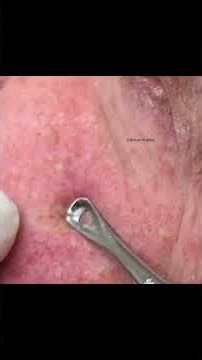 Extreme Solar Comedone Extraction