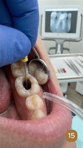 🦷 Root Canal Treatment Step by Step 😱 | Dental Instruments & Deep Cavity Cleaning | Dr S Rao