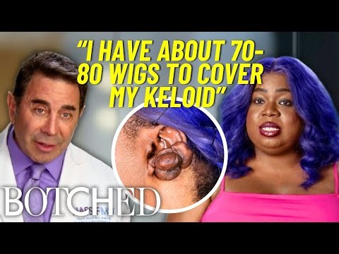This Patient Kept Her MASSIVE Ear Keloid Hidden Under Wigs After Piercing Gone Wrong | Botched | E!