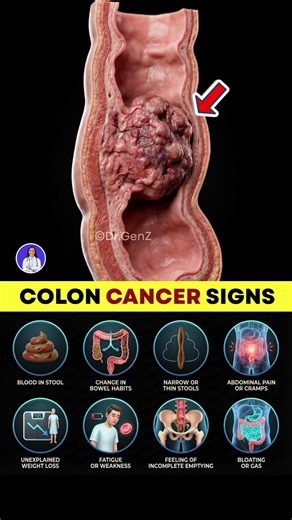 Early Warning Signs of Colon Cancer You Should Not Ignore