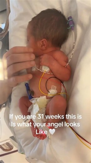 31 Weeks Premature Baby Life Journey😢😭 #prematurebaby #baby #newbornbaby #newborn #31weeksbaby