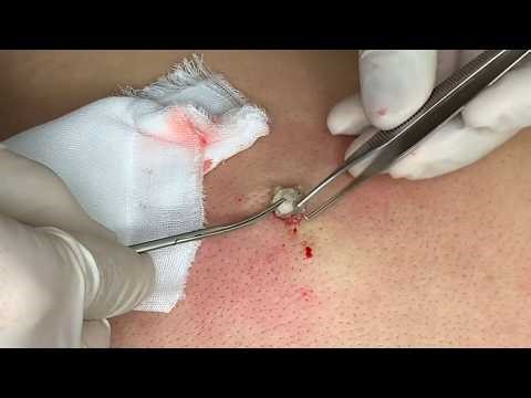 Satisfying Pimple Popping & Cyst Extractions - 202