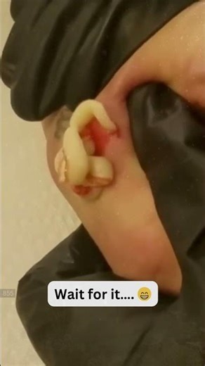 Large Blackheads Extraction Big Cystic Acne Blackheads&Whiteheads Removal Pimple Popping #1120 2026