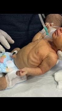 NICU Baby Recovery – Real Stories, Physio, & Shocking Transformations