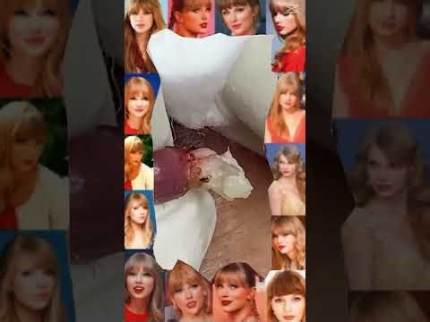 Blackheads Removal #318 | Acne Treatment and Very Satisfying Satisfying Pimple pop #blackheads