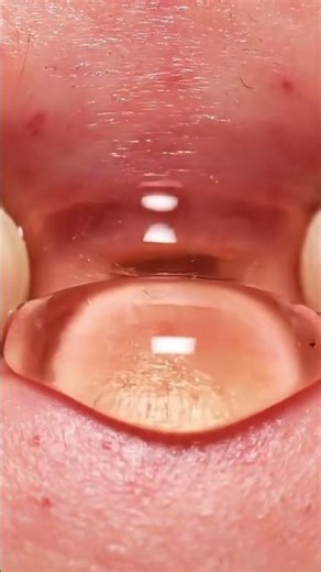 Extreme Pimple Popping Video #pimple #squeeze #dermatology
