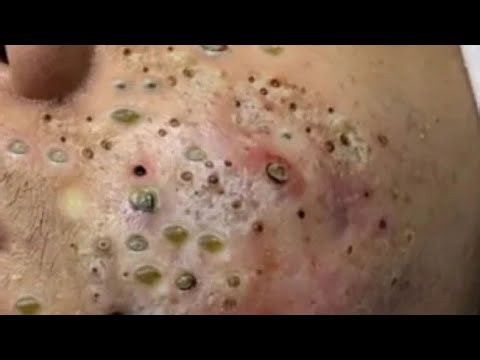 Deep blackhead Removal 2026, acne removal spa, big pimple 2026, #acne #pimple #cyst
