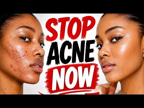 Acne Explained: Causes, Treatments & How to Get Clear Skin Fast