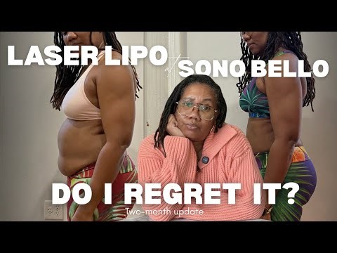 2 Month Laser Liposuction Update | Pain, Cost & Honest Thoughts | Before and After Photos
