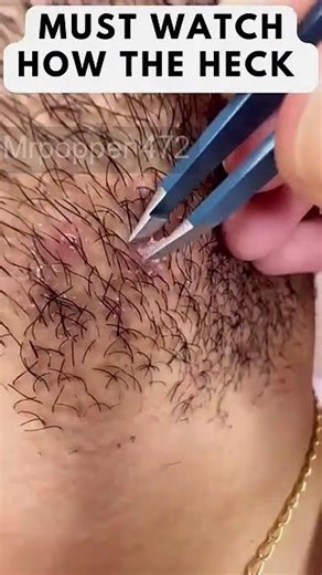 Removing large blackheads and pimples from face new 2026 #218