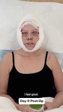 What My Facelift Recovery ACTUALLY Looked Like - Tami 4 Weeks Post-Op