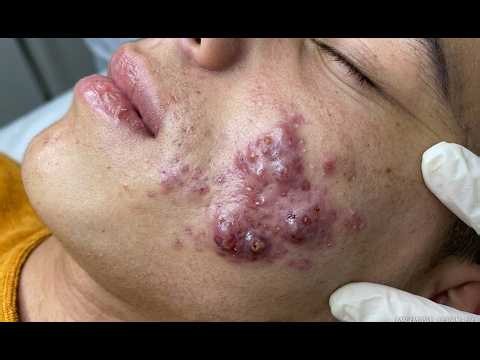 NEW 2026 - Extreme Facial Spa Treatment: Severe Acne & Deep Pore Cleansing#10383