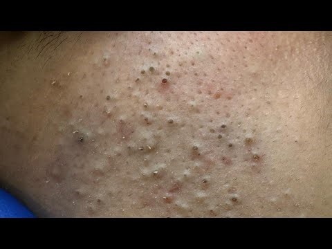 SATISFYING Blackheads Removal & Pimple Popping | Best Acne Treatment and Solutions