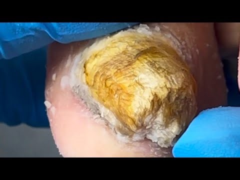 Thick And Coarse Onychomycosis, Remove The Bad Nails Little By Little【Podiatry Clinic】