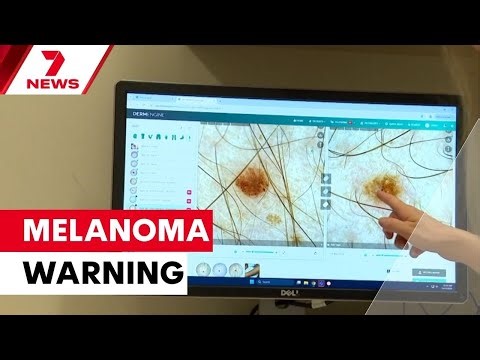 Teen melanoma trend sparks health concerns | 7NEWS