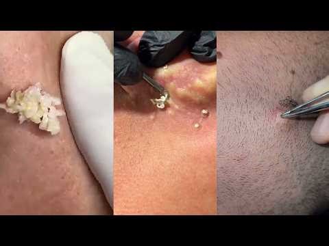 Popping huge blackheads and Pimple Popping - Best Pimple Popping Videos 297