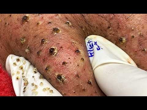 Extreme Blackhead Removal #1 | Satisfying Pimple Pop & Deep Skin Cleaning #Blackheads