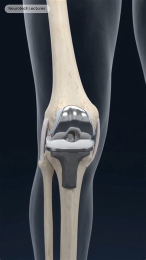 Total Knee Replacement Surgery in 3D #medicalanimation #health