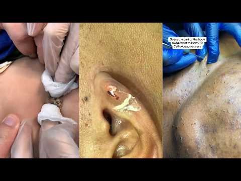 Popping huge blackheads and Pimple Popping - Best Pimple Popping Videos 306