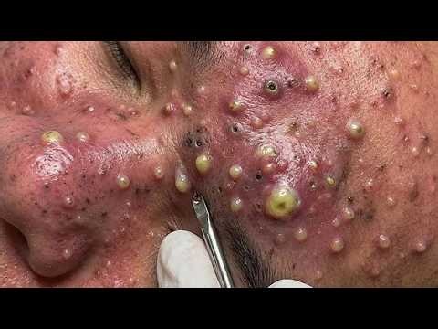 Big Cystic Blackhcads Extraction Blackheads & Milia, Whitchcads Removal #2059