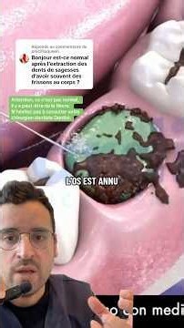 Les complications de l’extraction dentaire : comprendre l’alvéolite