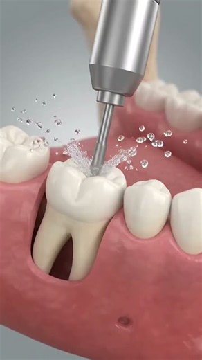 How Wisdom Tooth Extraction Actually Works #viral #ai #health #aivideo #toothsi