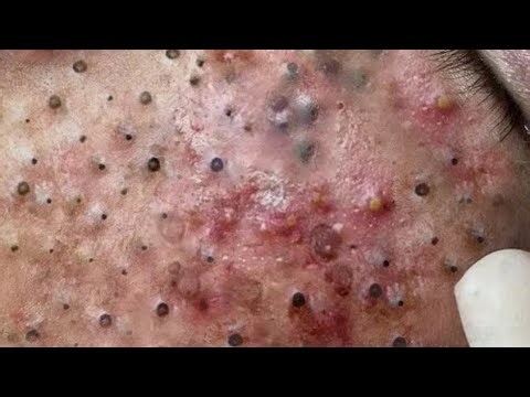 Deep blackhead Removal 2026, acne removal spa, big pimple 2026, #acne #pimple #cyst