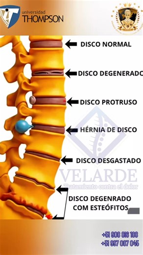 Los discos intervertebrales pueden dañarse debido al desgaste, la mala postura o lesiones, lo que puede provocar problemas como hernias o degeneración #herniadedisco #saludybienestar #saludable #asmr #hernia