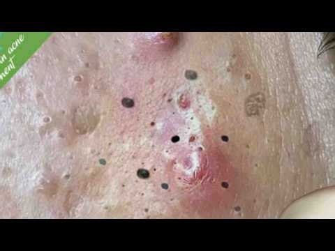 Deep blackhead Removal 2026, acne removal spa, big pimple 2026, #acne #pimple #cyst