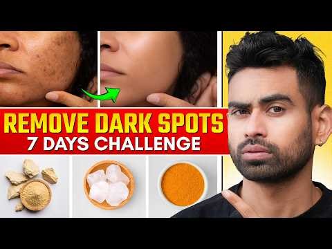 Get Rid of Skin Pigmentation in 4 Steps (No More Dark Spots/ Acne Marks)