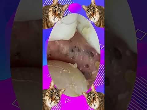 Satisfying Blackhead Removal | Acne Treatment, Pimple Pop & Deep Skin Clean-Up