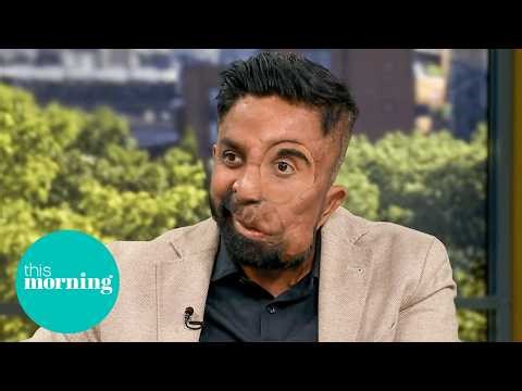 Amit Ghose Opens Up On Living With a Visible Difference | This Morning