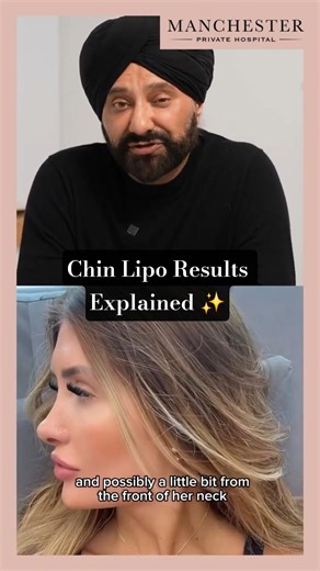 Chin Liposuction Results Explained by Dr Kam Singh | VASER Jawline Sculpting