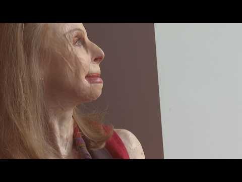North Carolina plane crash survivor changes way people see disfigurement