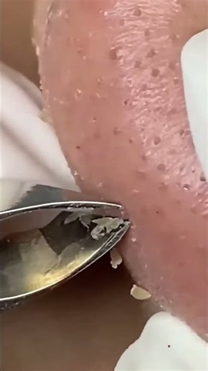 BLACKHEAD REMOVAL #006