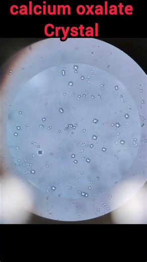 calcium oxalate present in urine microscopy🔬 |#calciumoxalate #urinalysis#shorts #clinicalpathology
