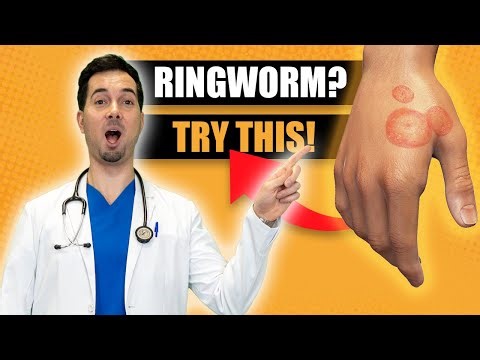 How To Get Rid of Ringworm Fast